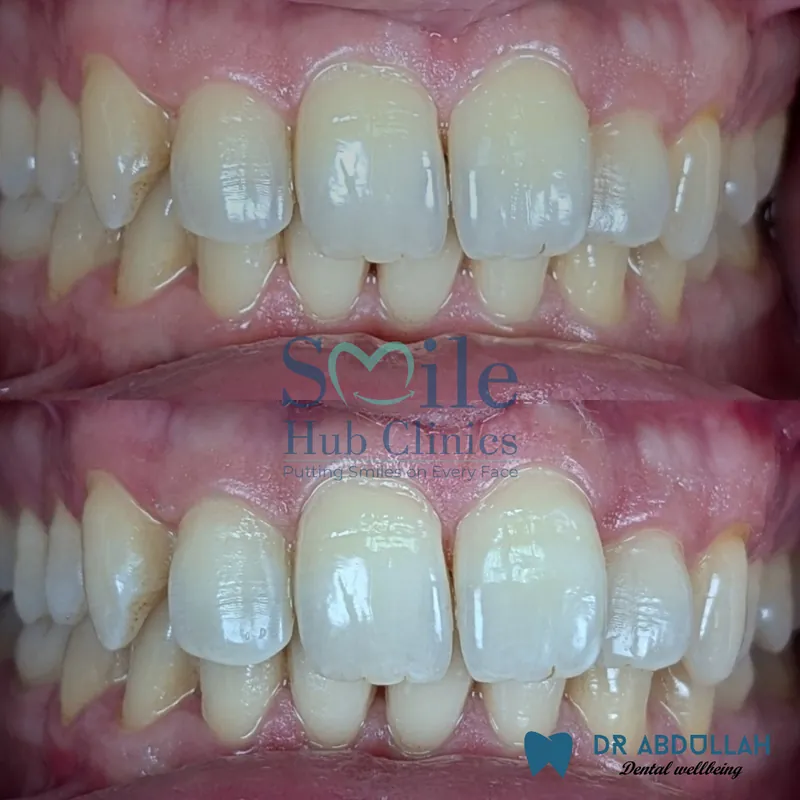 Professional Teeth Whitening before and after — Smile Hub Clinics, Johar Town, Lahore