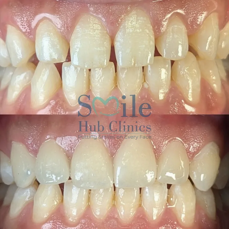 E.max veneers before and after, space closure — Smile Hub Clinics, Johar Town, Lahore