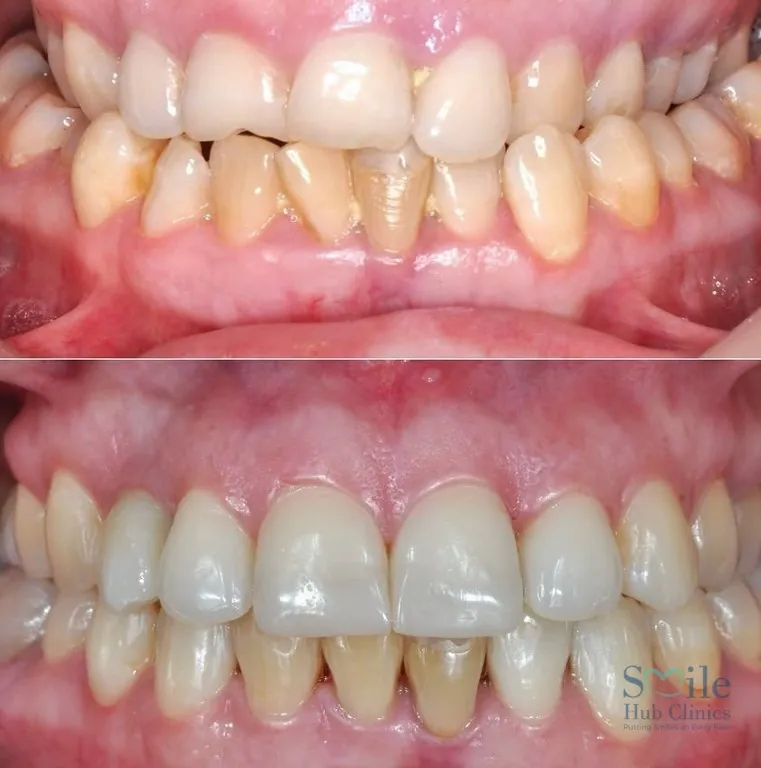 E.max veneer smile makeover before and after — Smile Hub Clinics, Lahore