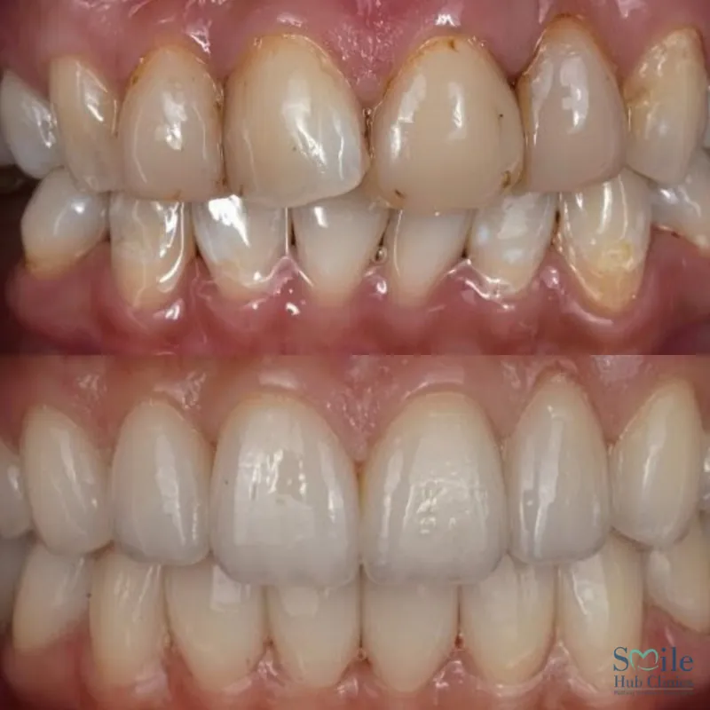 Veneer smile makeover before and after — Smile Hub Clinics, Johar Town