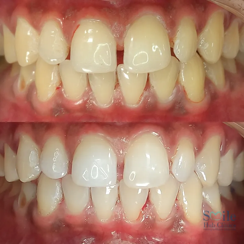 Professional Teeth Whitening before and after — Smile Hub Clinics, Johar Town, Lahore