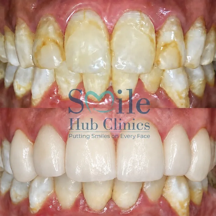 E.max veneers smile transformation before and after — Smile Hub Clinics, Lahore