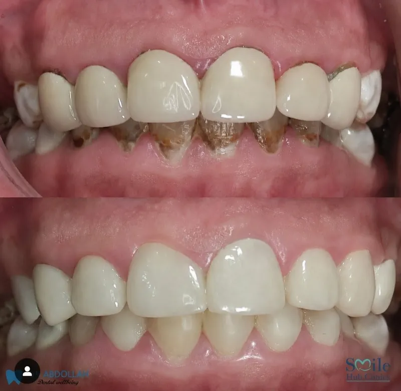Crown Upgrade before and after — Smile Hub Clinics, Johar Town, Lahore