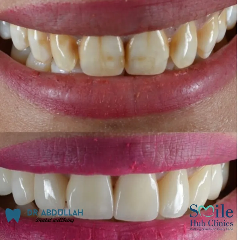 Veneers for fluorosis staining before and after — Smile Hub Clinics, Lahore