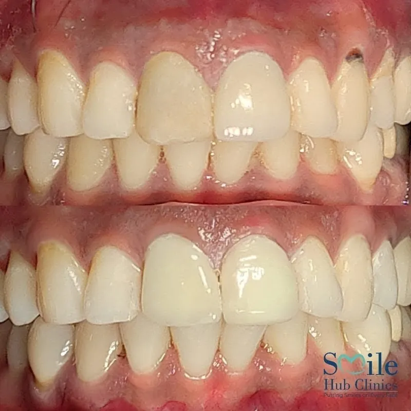 Veneer Replacement before and after — Smile Hub Clinics, Johar Town, Lahore