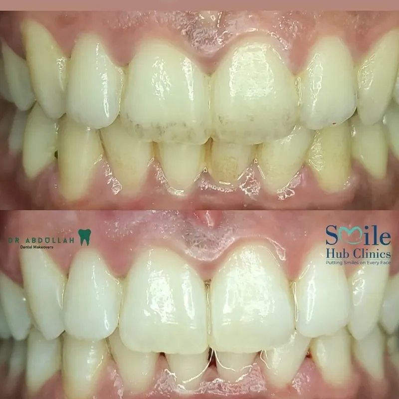 Professional Teeth Whitening before and after — Smile Hub Clinics, Johar Town, Lahore