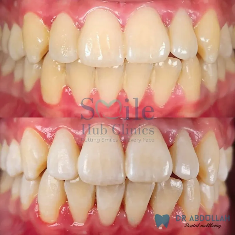Professional Teeth Whitening before and after — Smile Hub Clinics, Johar Town, Lahore