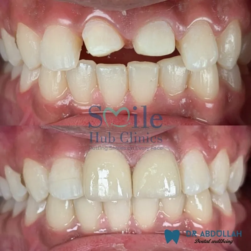 Crowns for Broken Front Teeth before and after — Smile Hub Clinics, Johar Town, Lahore