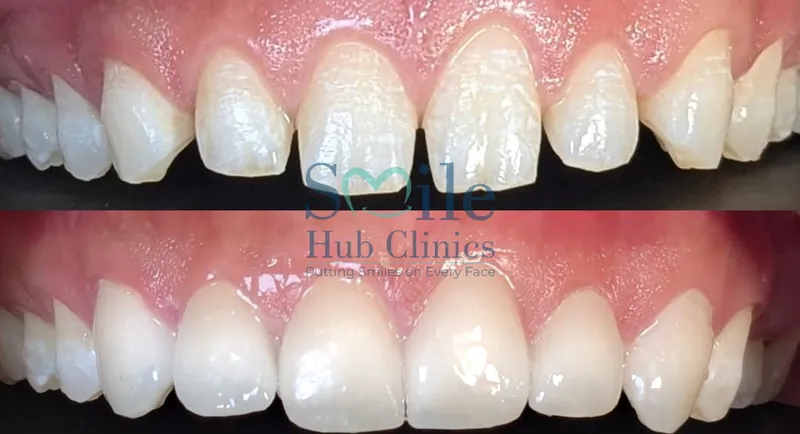 E.max veneers space closure before and after — Smile Hub Clinics, Johar Town