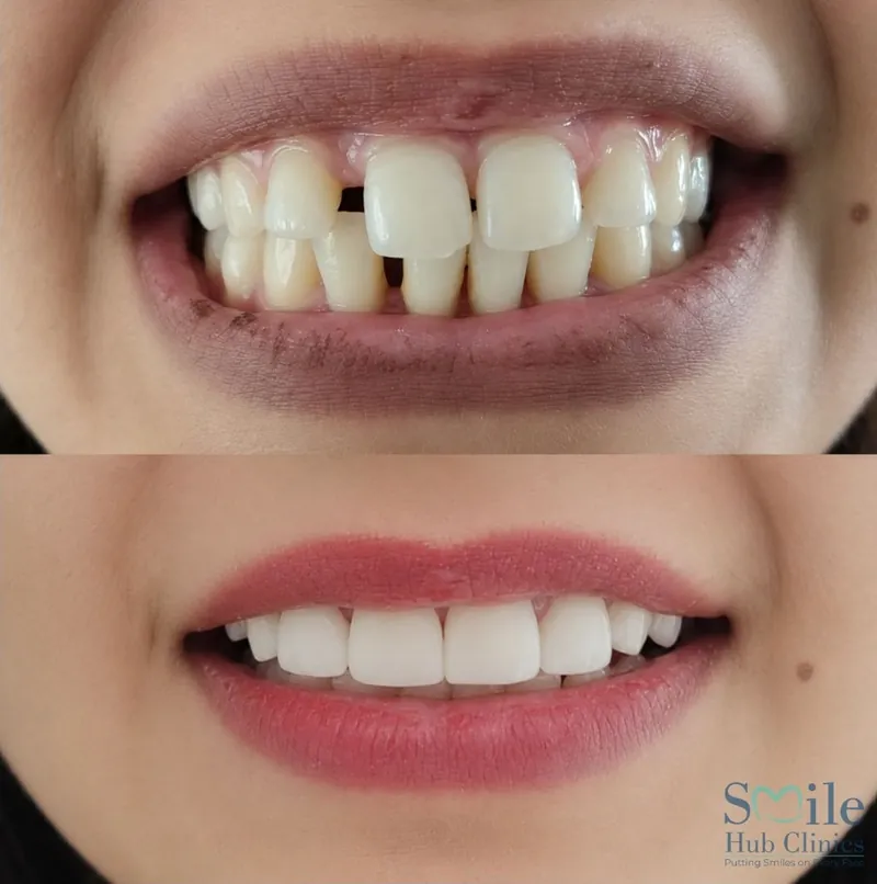 Veneer smile makeover before and after — Smile Hub Clinics, Lahore