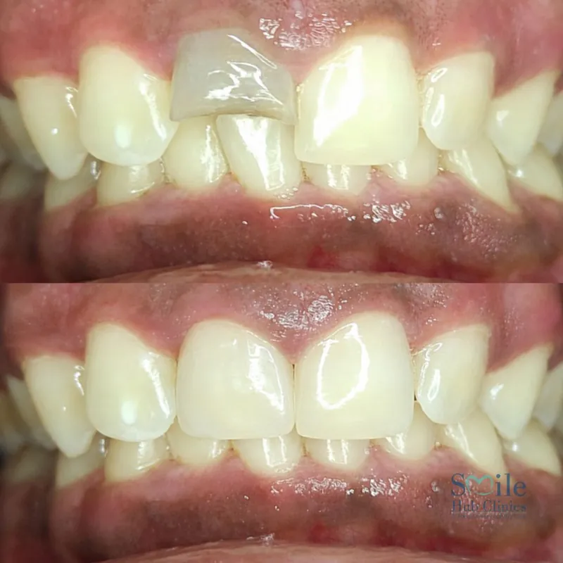 Whitening & Crown Restoration before and after — Smile Hub Clinics, Johar Town, Lahore
