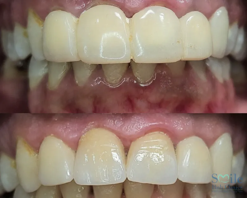 Crown Makeover before and after — Smile Hub Clinics, Johar Town, Lahore