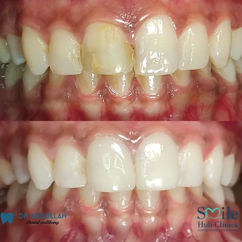 Whitening & Veneers before and after — Smile Hub Clinics, Johar Town, Lahore