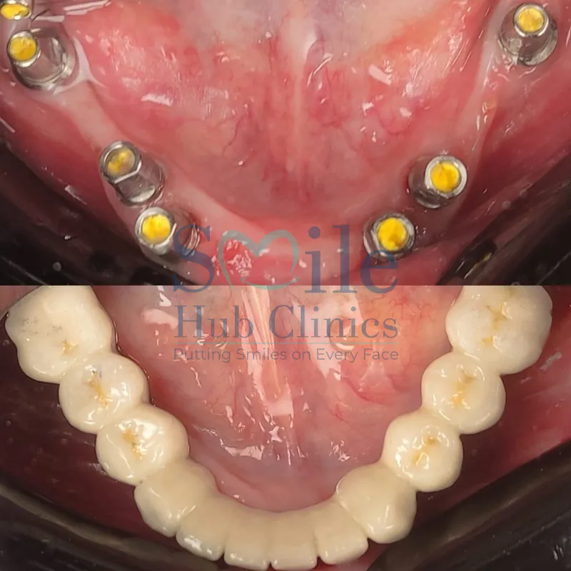 Multiple Dental Implants before and after — Smile Hub Clinics, Johar Town, Lahore