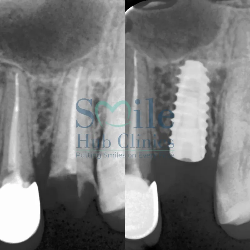 Single Dental Implant before and after — Smile Hub Clinics, Johar Town, Lahore