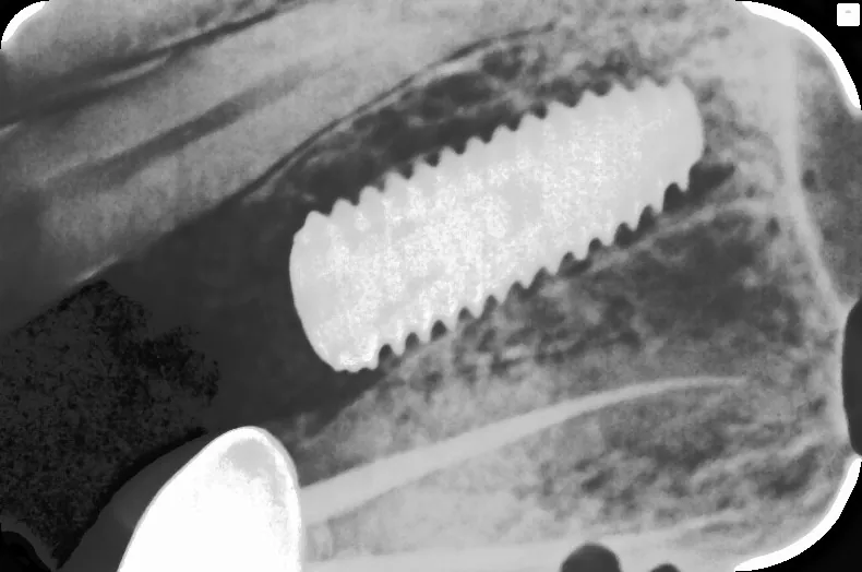 Single Implant Placement before and after — Smile Hub Clinics, Johar Town, Lahore