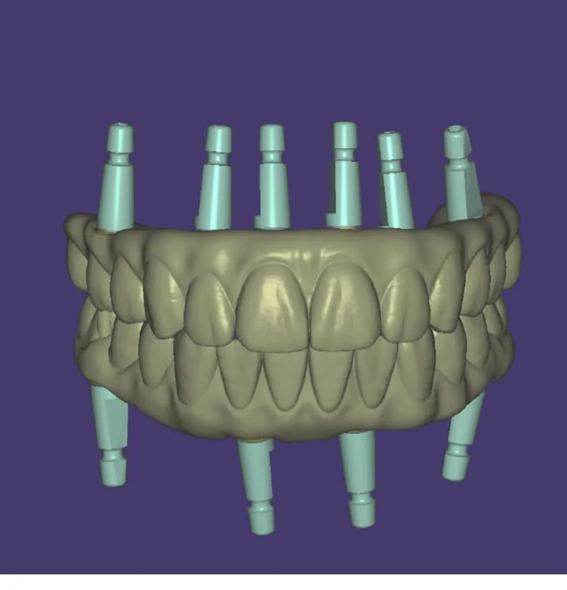 Full-Arch Implant Plan before and after — Smile Hub Clinics, Johar Town, Lahore
