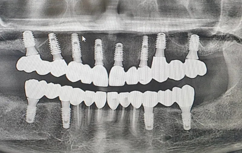Full-Mouth Implant Rehabilitation before and after — Smile Hub Clinics, Johar Town, Lahore