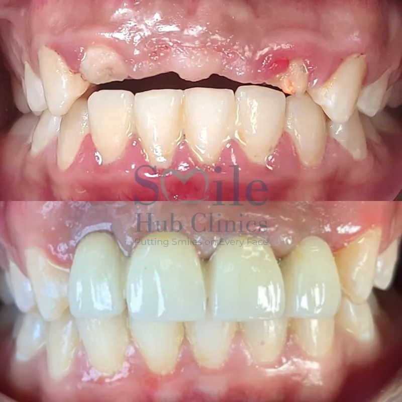 Front-Tooth Implants before and after — Smile Hub Clinics, Johar Town, Lahore