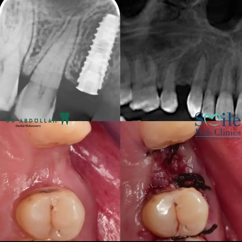 Single Molar Implant before and after — Smile Hub Clinics, Johar Town, Lahore