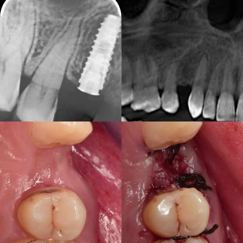 Single-Tooth Implant before and after — Smile Hub Clinics, Johar Town, Lahore
