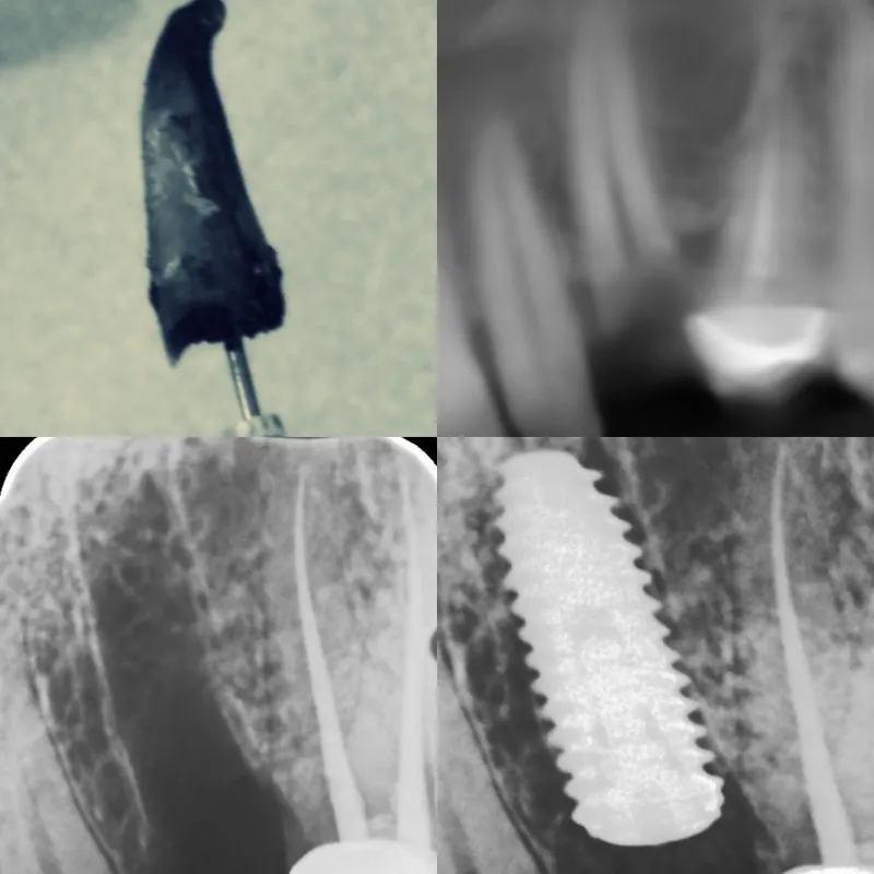 Implant for Fractured Tooth before and after — Smile Hub Clinics, Johar Town, Lahore
