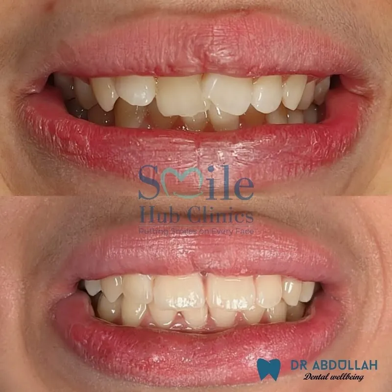 Clear aligners before and after, teeth straightening — Smile Hub Clinics, Johar Town, Lahore