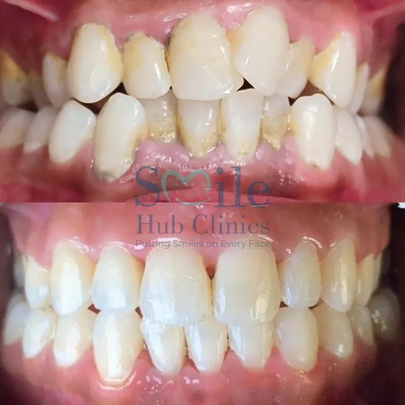 Braces for Crowding before and after — Smile Hub Clinics, Johar Town, Lahore