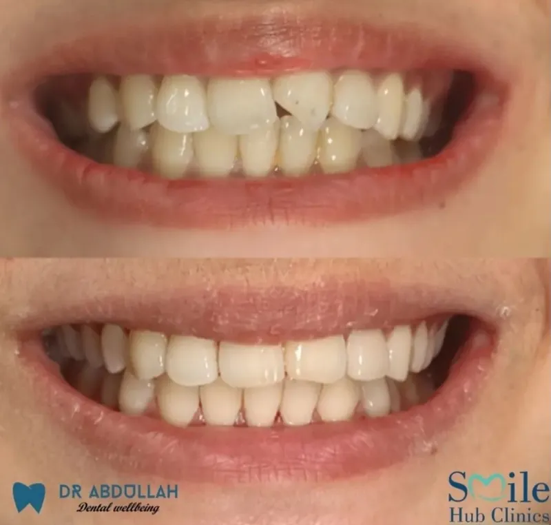 Clear aligner treatment before and after — Smile Hub Clinics, Lahore