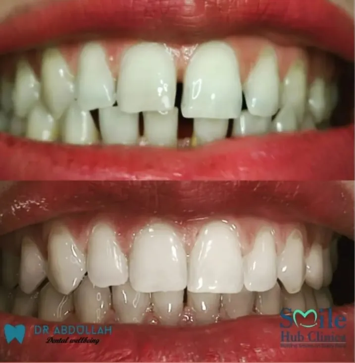 Aligners for crowding before and after — Smile Hub Clinics, Johar Town
