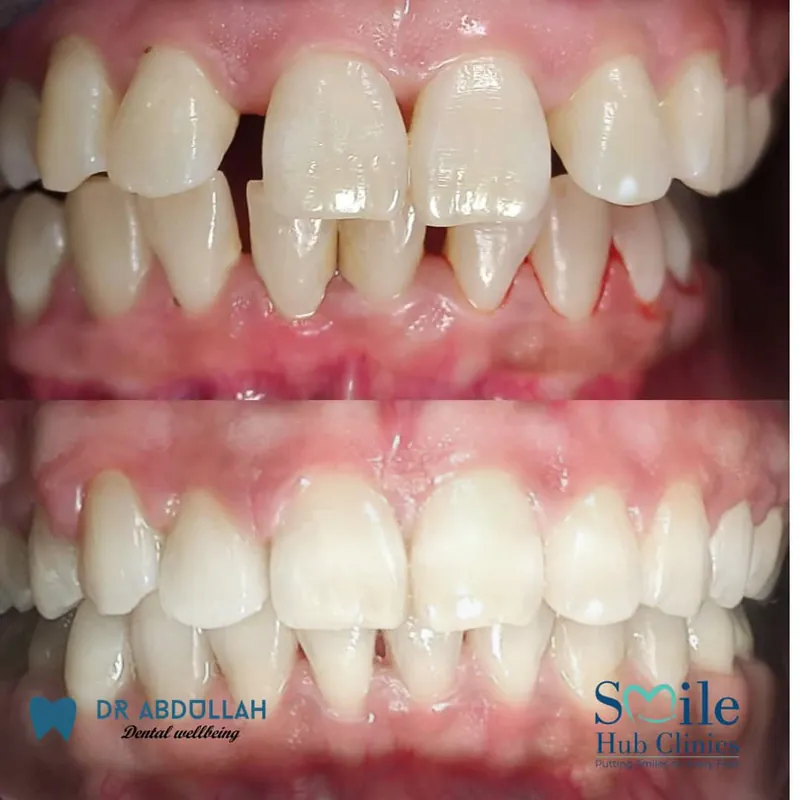 Braces for Spacing before and after — Smile Hub Clinics, Johar Town, Lahore