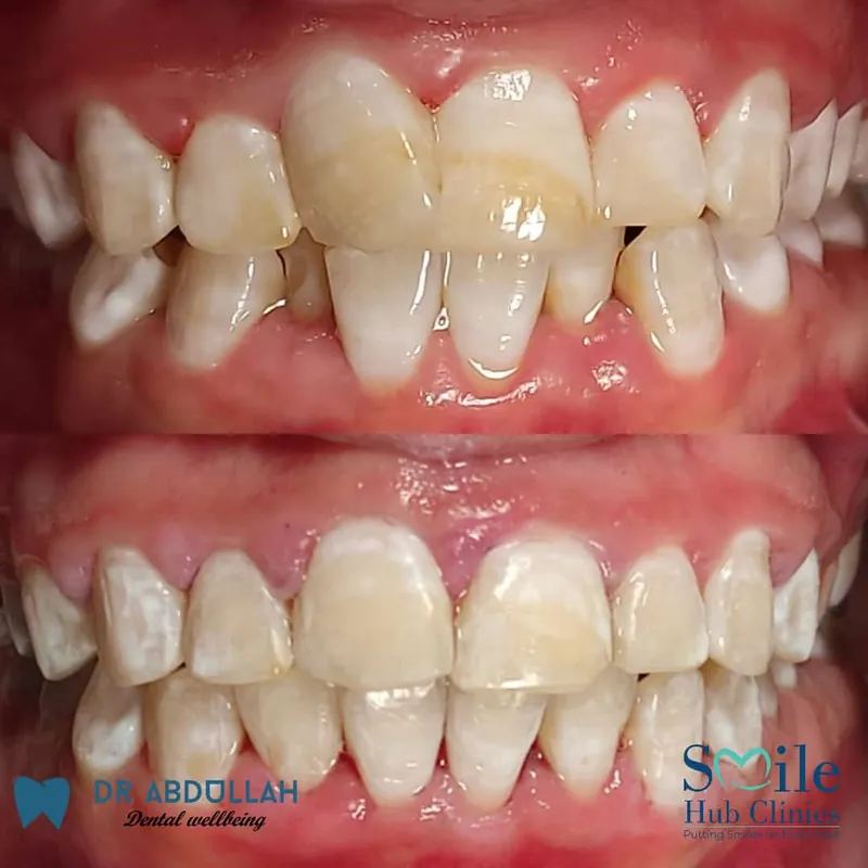 Braces for Crowding before and after — Smile Hub Clinics, Johar Town, Lahore