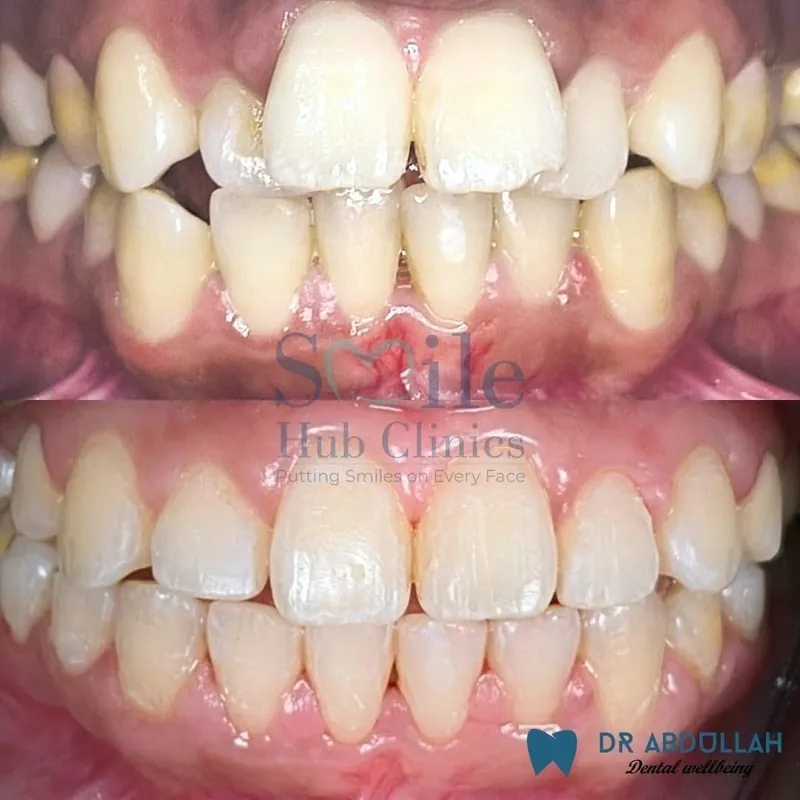 Braces for Crowding before and after — Smile Hub Clinics, Johar Town, Lahore