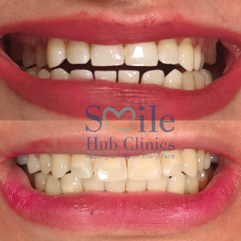 Aligners for spacing before and after — Smile Hub Clinics, Johar Town