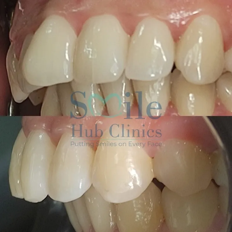 Clear aligner alignment before and after — Smile Hub Clinics, Lahore