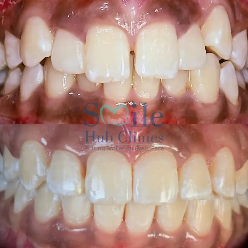 Braces for Crowding before and after — Smile Hub Clinics, Johar Town, Lahore