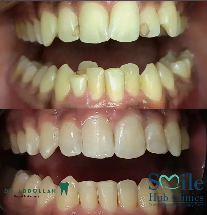 Braces for Crowding before and after — Smile Hub Clinics, Johar Town, Lahore