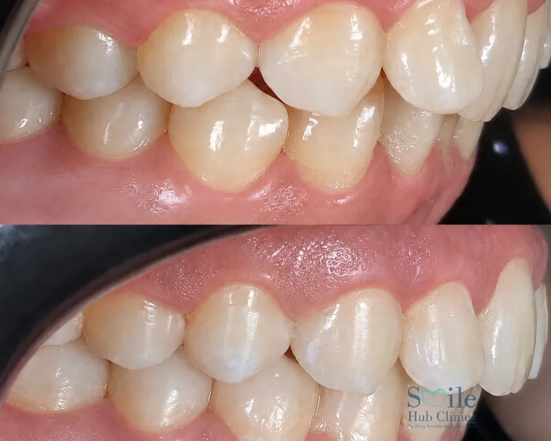 Aligner teeth straightening before and after — Smile Hub Clinics, Johar Town