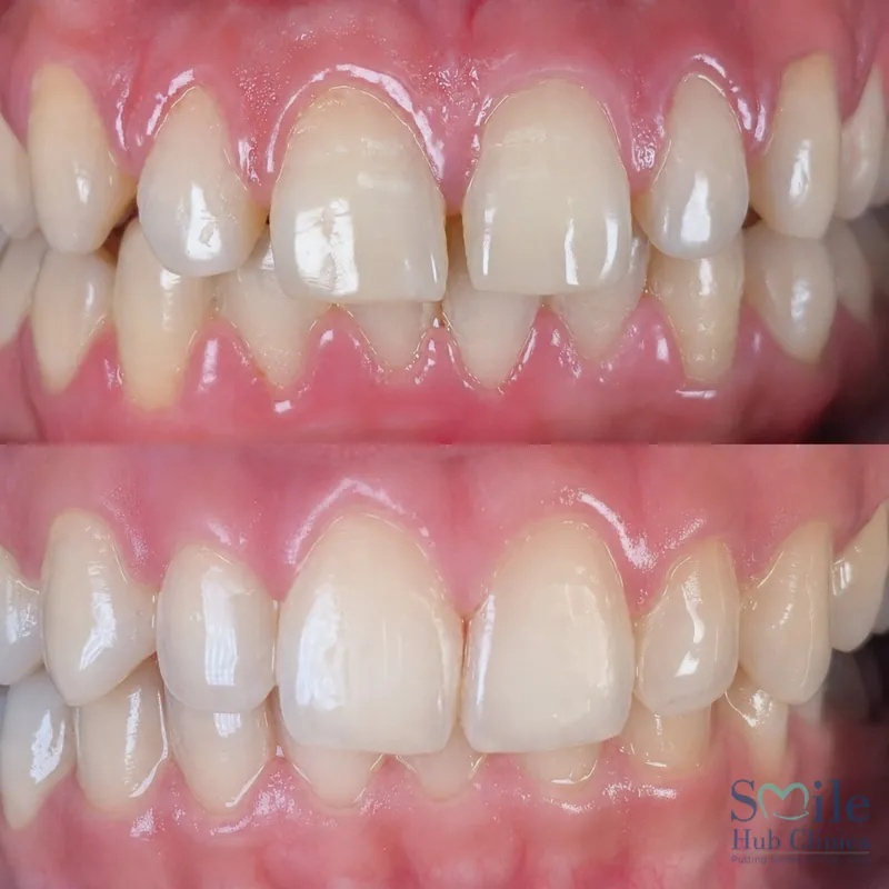 Clear aligners for spacing before and after — Smile Hub Clinics, Lahore