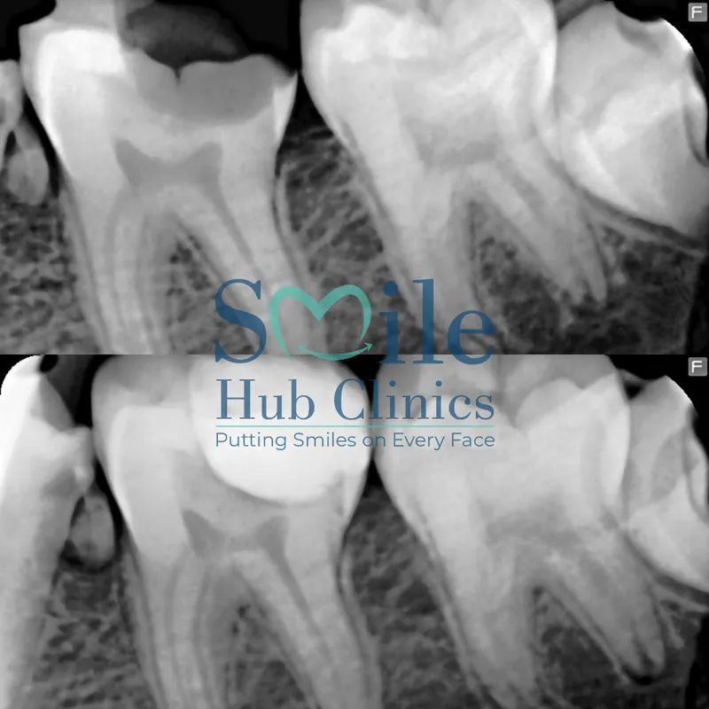 Root Canal Treatment before and after — Smile Hub Clinics, Johar Town, Lahore