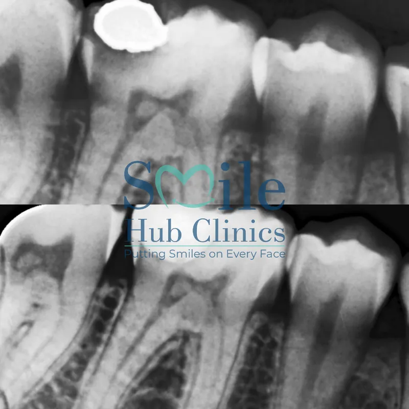 Root Canal & Restoration before and after — Smile Hub Clinics, Johar Town, Lahore
