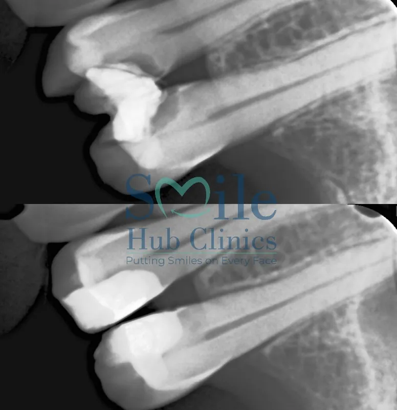 Broken Tooth Rebuilt before and after — Smile Hub Clinics, Johar Town, Lahore