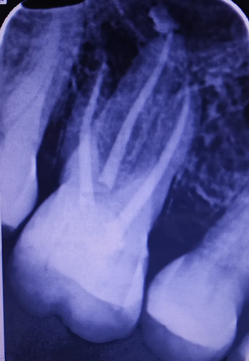 Root Canal Treatment before and after — Smile Hub Clinics, Johar Town, Lahore