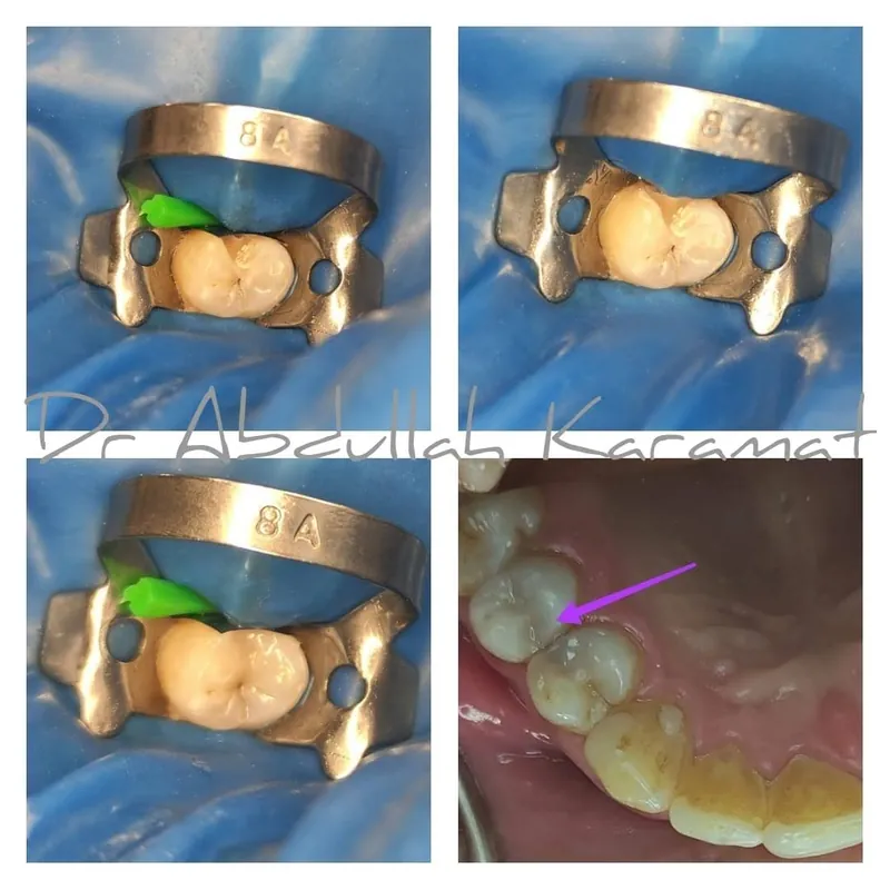 Filling Restoration before and after — Smile Hub Clinics, Johar Town, Lahore