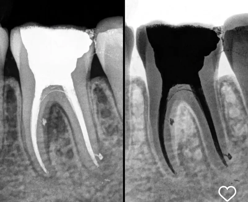 Molar Root Canal before and after — Smile Hub Clinics, Johar Town, Lahore