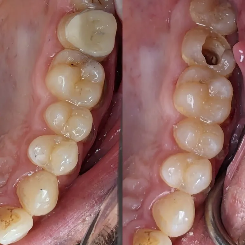 Endocrown Restoration before and after — Smile Hub Clinics, Johar Town, Lahore