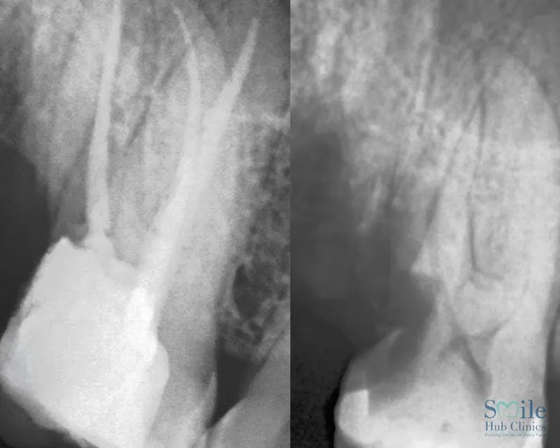 Root Canal Treatment before and after — Smile Hub Clinics, Johar Town, Lahore
