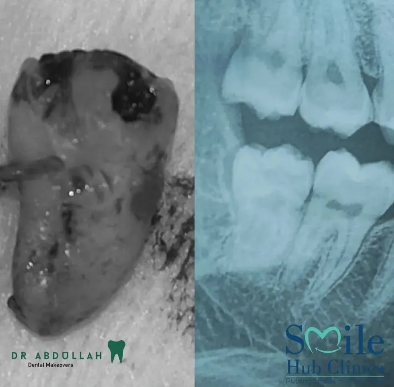 Surgical Extraction before and after — Smile Hub Clinics, Johar Town, Lahore