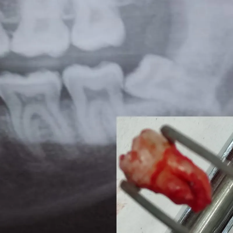 Painless Tooth Extraction before and after — Smile Hub Clinics, Johar Town, Lahore
