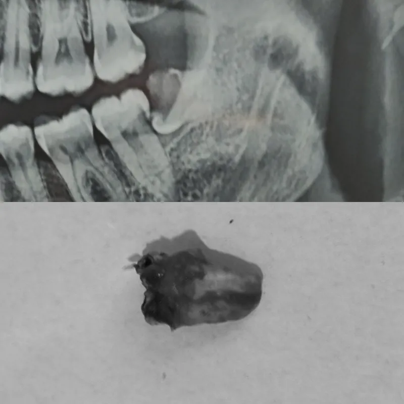 Impacted Wisdom Tooth Removal before and after — Smile Hub Clinics, Johar Town, Lahore